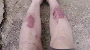 小腿皮肤皲裂赭肿~翼鸣医案