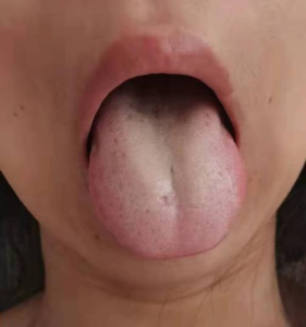 误治后遇冷咳嗽