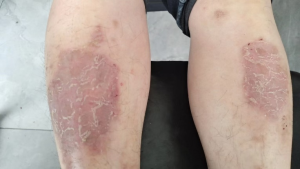 小腿皮肤皲裂赭肿~翼鸣医案