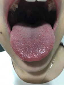 闭经