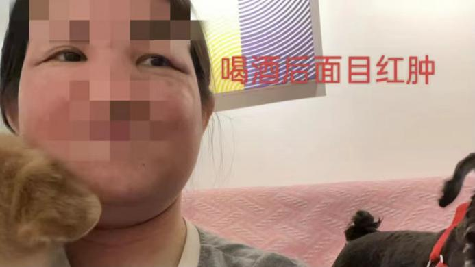 饮酒后面目红肿