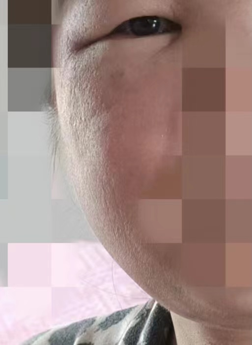饮酒后面目红肿