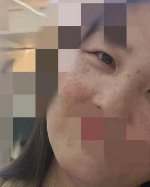 饮酒后面目红肿
