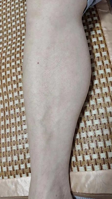 二十年皮肤病用升解汤治愈